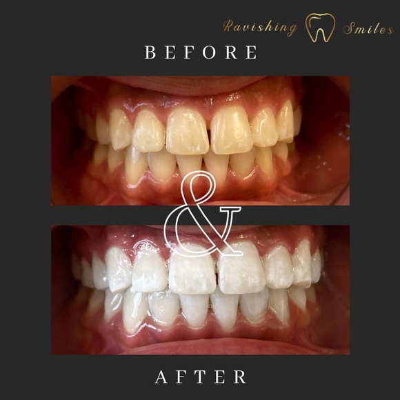 16% Hydrogen Peroxide Teeth Whitening Kit. (Unisex) - Picture 2 of 4